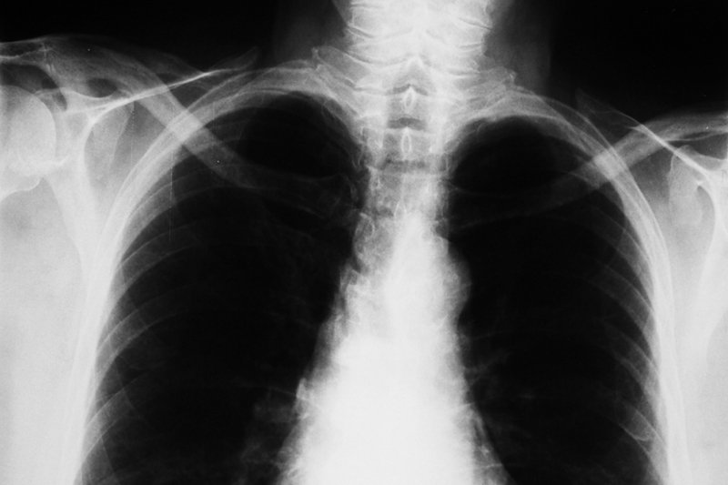 Czy choroba, która przed stu laty dziesiątkowała środowiska artystyczne w całej Europie, wciąż jest groźna? We wrocławskiej szkole odnotowano przypadek gruźlicy.