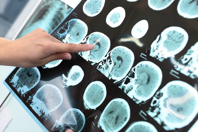 Choroby mózgu dotykają coraz częściej młodych osób.