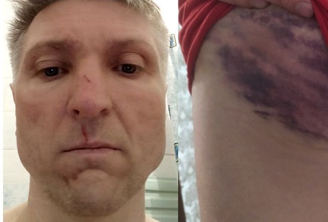 Igor Stankievicz, Polak pobity przez OMON, pokazał rozległe obrażenia.