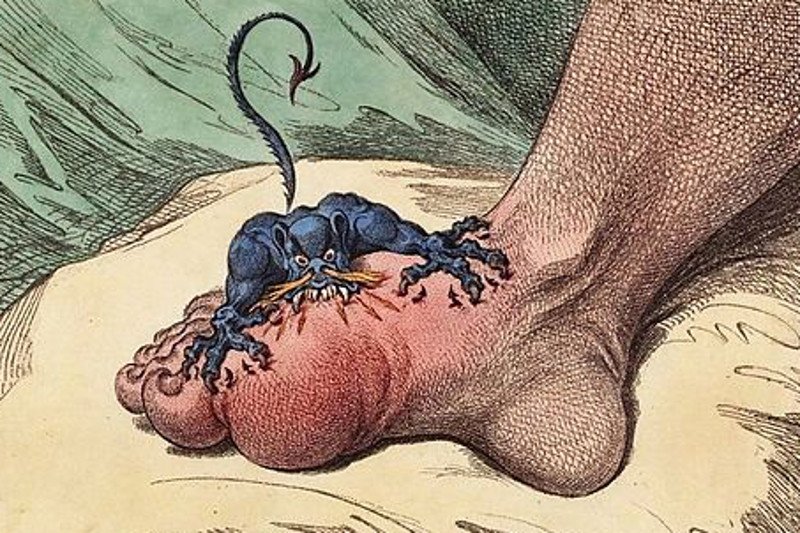 Grafika Jamesa Gillraya przedstawiająca karykaturalnie atak dny moczanowej.