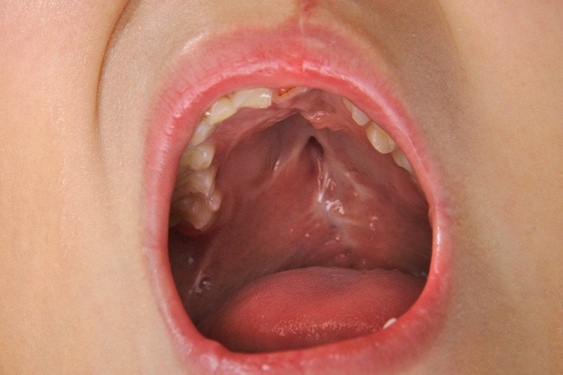 Rozszczep podniebienia u dziecka.