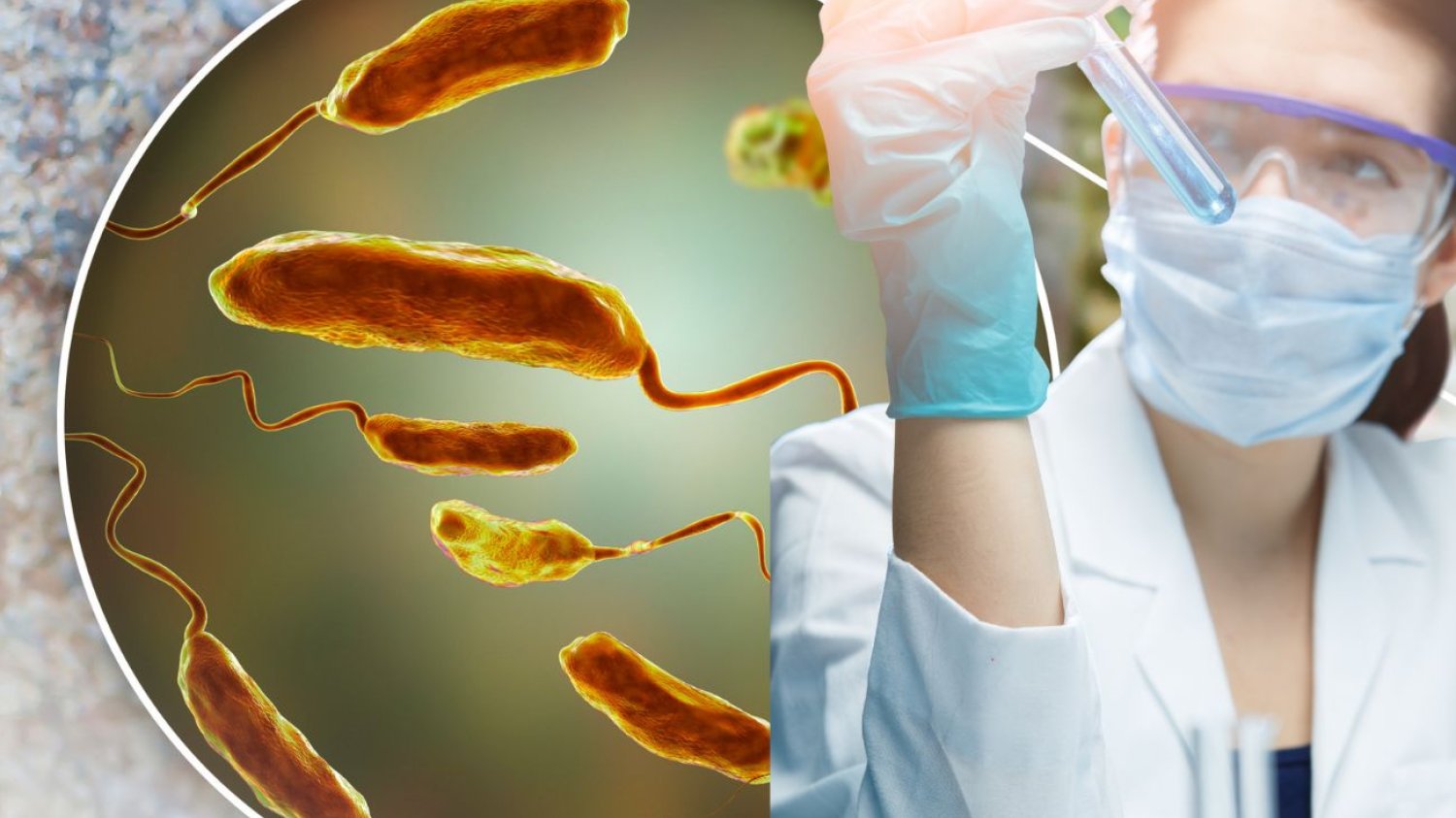 Wibrioza i cholera to choroby zakaźne wywoływane przez bakterie z rodzaju Vibrio. W Polsce mamy pierwsze przypadki wibriozy, która na początku brana była za cholerę. Tak właśnie było z pacjentką ze Stargardu, o której mówiły wszystkie media. Wibrioza i cholera to choroby zakaźne wywoływane przez bakterie z rodzaju Vibrio. W Polsce mamy pierwsze przypadki wibriozy, która na początku brana była za cholerę. Tak właśnie było z pacjentką ze Stargardu, o której mówiły wszystkie media.
