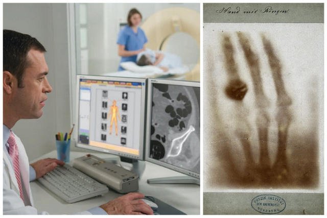 Technika iDose firmy Philips umożliwia obniżenie dawki promieniowania nawet o 80% bez utraty jakości obrazu. Po prawej: zdjęcie dłoni żony Röntgena wykonane przez niego samego (1896 r.)
