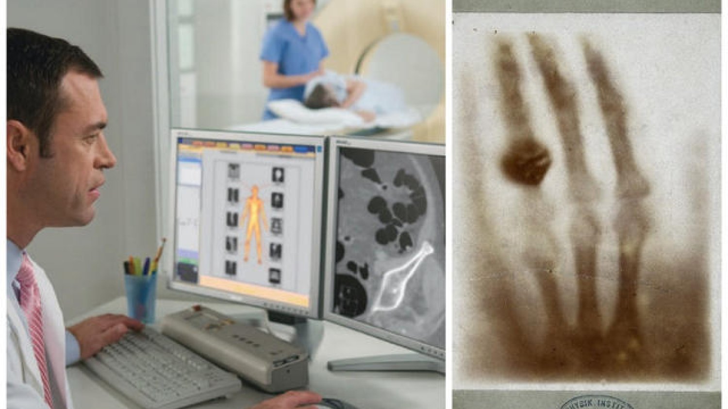 Technika iDose firmy Philips umożliwia obniżenie dawki promieniowania nawet o 80% bez utraty jakości obrazu. Po prawej: zdjęcie dłoni żony Röntgena wykonane przez niego samego (1896 r.)