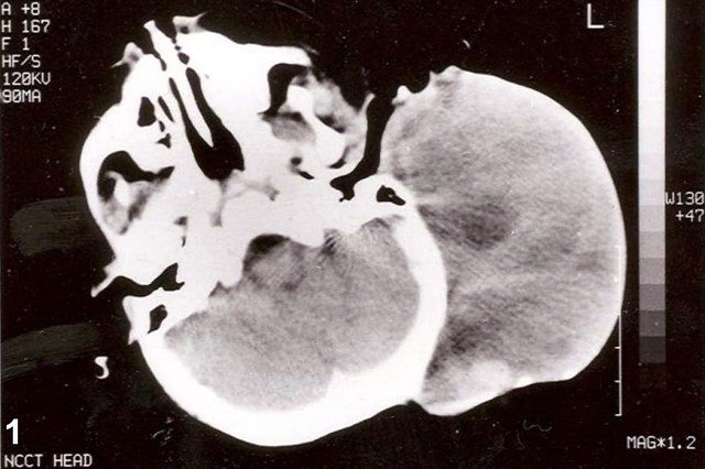 Zdrowy tryb życia nie gwarantuje, że człowiek nie zachoruje na nowotwór