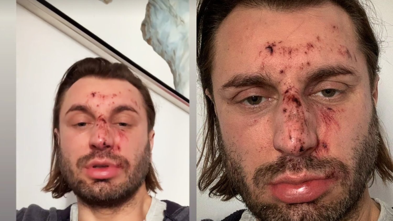 Rafał Grabias z "Królowych życia" został dotkliwie pobity. Pokazał zdjęcia