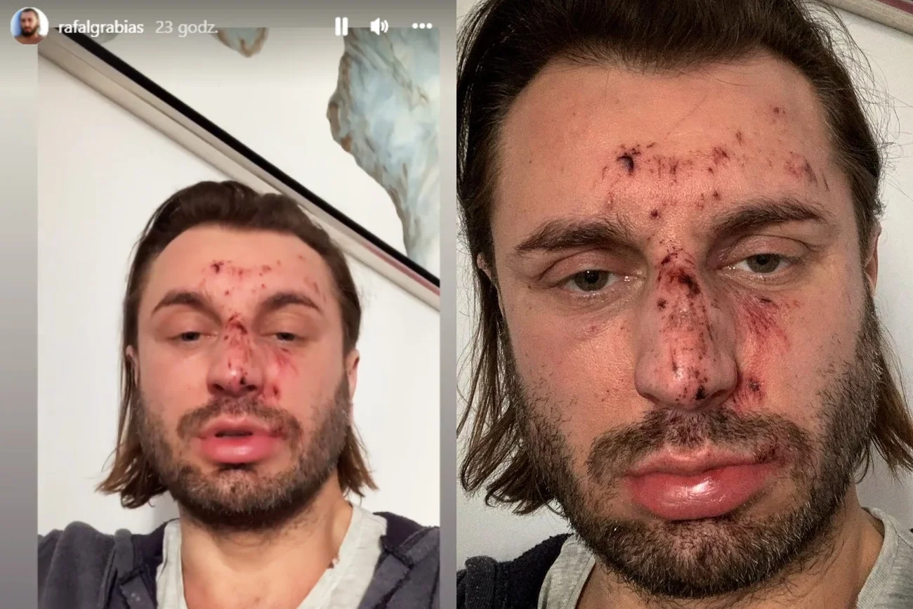 Rafał Grabias z "Królowych życia" został dotkliwie pobity. Pokazał zdjęcia