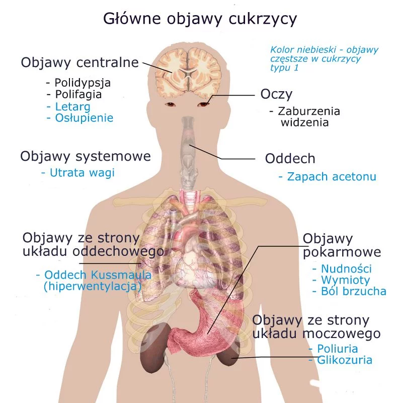Jakie są klasyczne objawy cukrzycy? Objawy cukrzycy: charakterystyczne, nietypowe, skórne. Jak je rozpoznać?