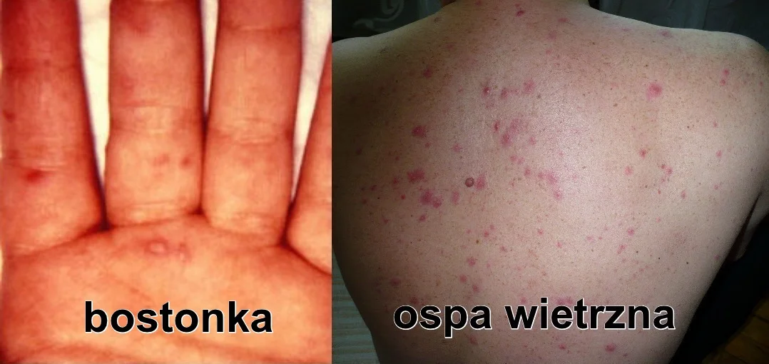 Po lewej zmiany skórne charakterystyczne dla bostonki. Po prawej krosty na plecach u pacjenta z ospą wietrzną.