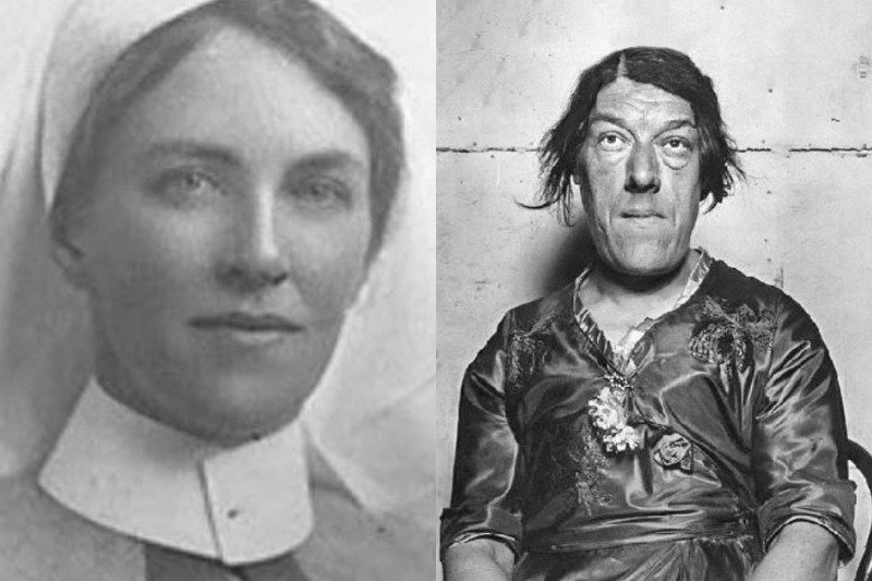 Mary Ann Bevan, znana jako "najbrzydsza kobieta świata", cierpiała na akromegalię.