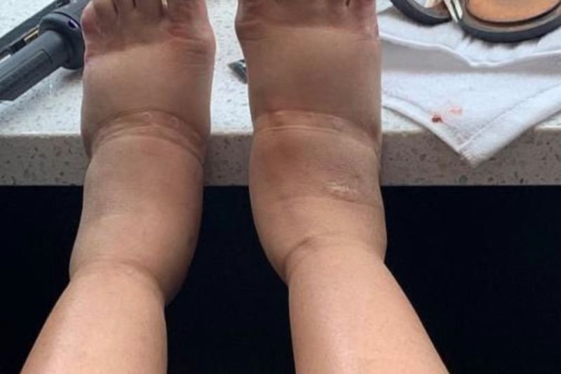 Piosenkarka odczuwa bolesne skutki uboczne operacji powiększenia piersi.