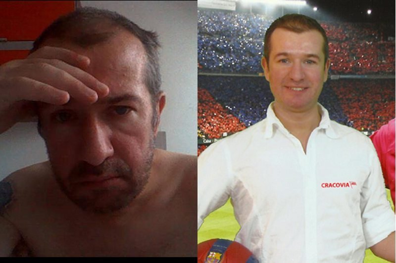 Jerzy Burkat PO i PRZED operacją