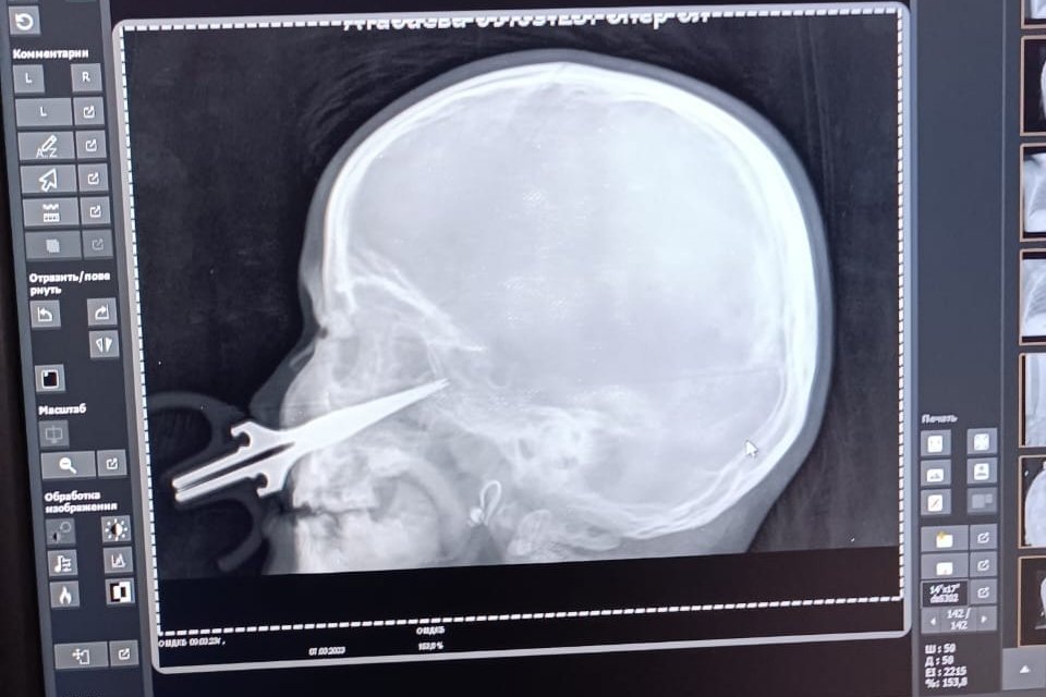 Nożyczki wbiły się dziewczynce w twarz.