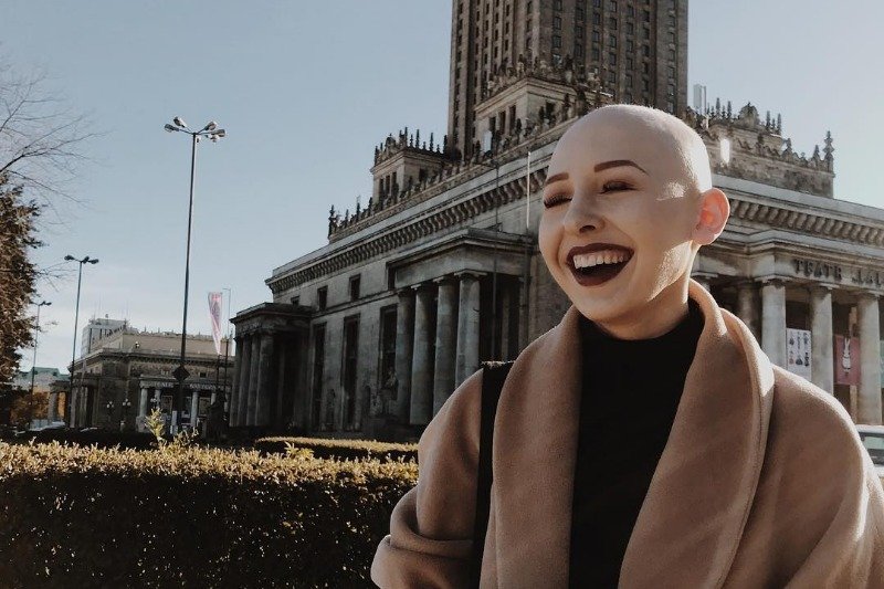 Ola cierpi na łysienie plackowate, ale zamiast się załamywać, udowadnia, że można żyć normalnie