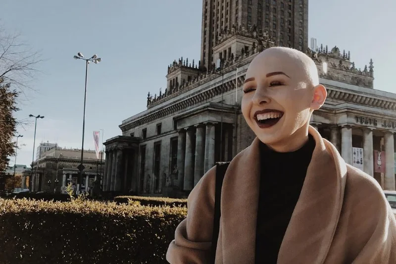 Ola cierpi na łysienie plackowate, ale zamiast się załamywać, udowadnia, że można żyć normalnie