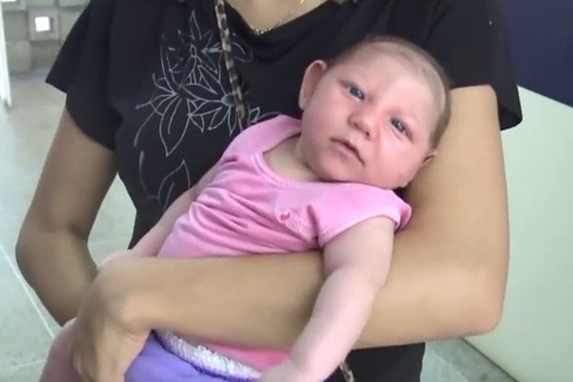 Wirus Zika powoduje małogłowie u dzieci matek, które podczas ciąży uległy zakażeniu.