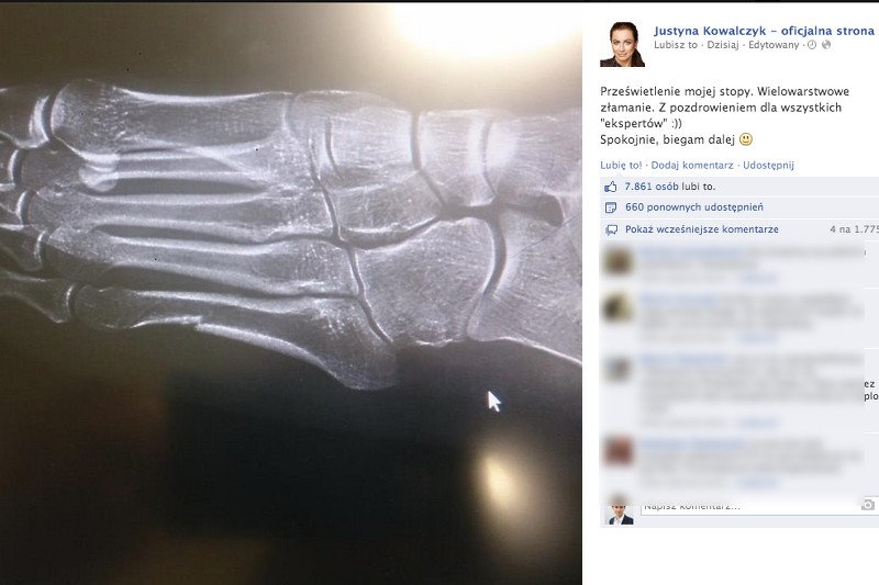 Justyna Kowalczyk ma złamaną stopę