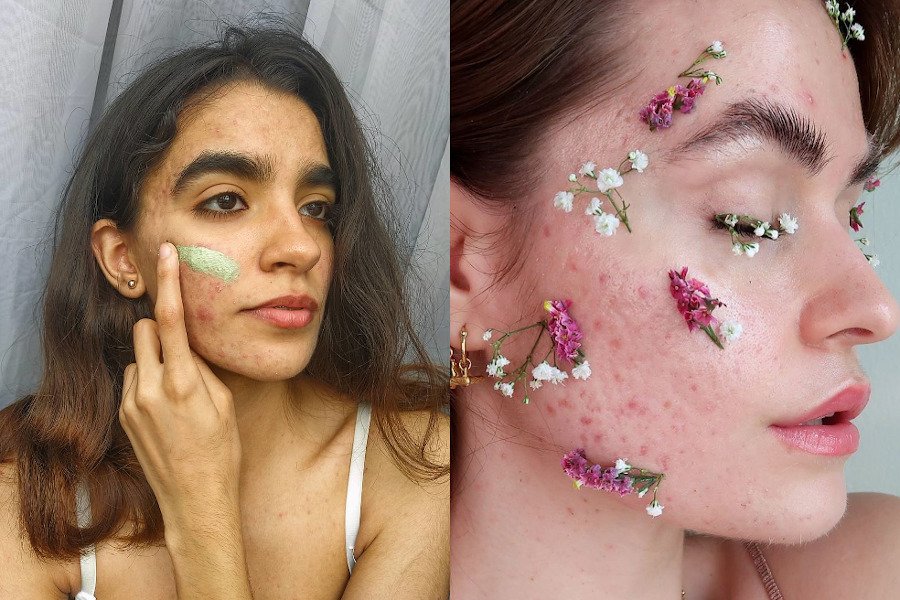 Ruch #acnepositivity walczy z kompleksami na punkcie cery