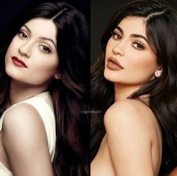 Zaledwie 20-letnia Kylie Jenner przed i po operacjach