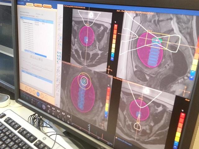 Wszystkie działania systemu Philips Sonalleve MR-HIFU są nieustannie monitorowane i kontrolowane.