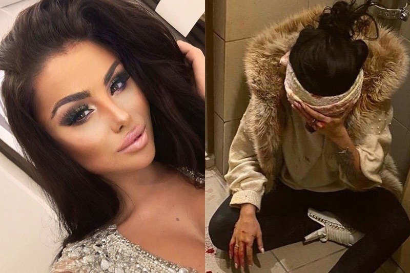 Julia Kupiec czeka teraz na zdjęcie szwów.