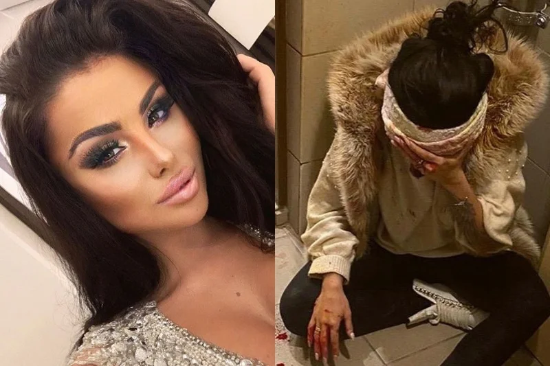 Julia Kupiec czeka teraz na zdjęcie szwów.