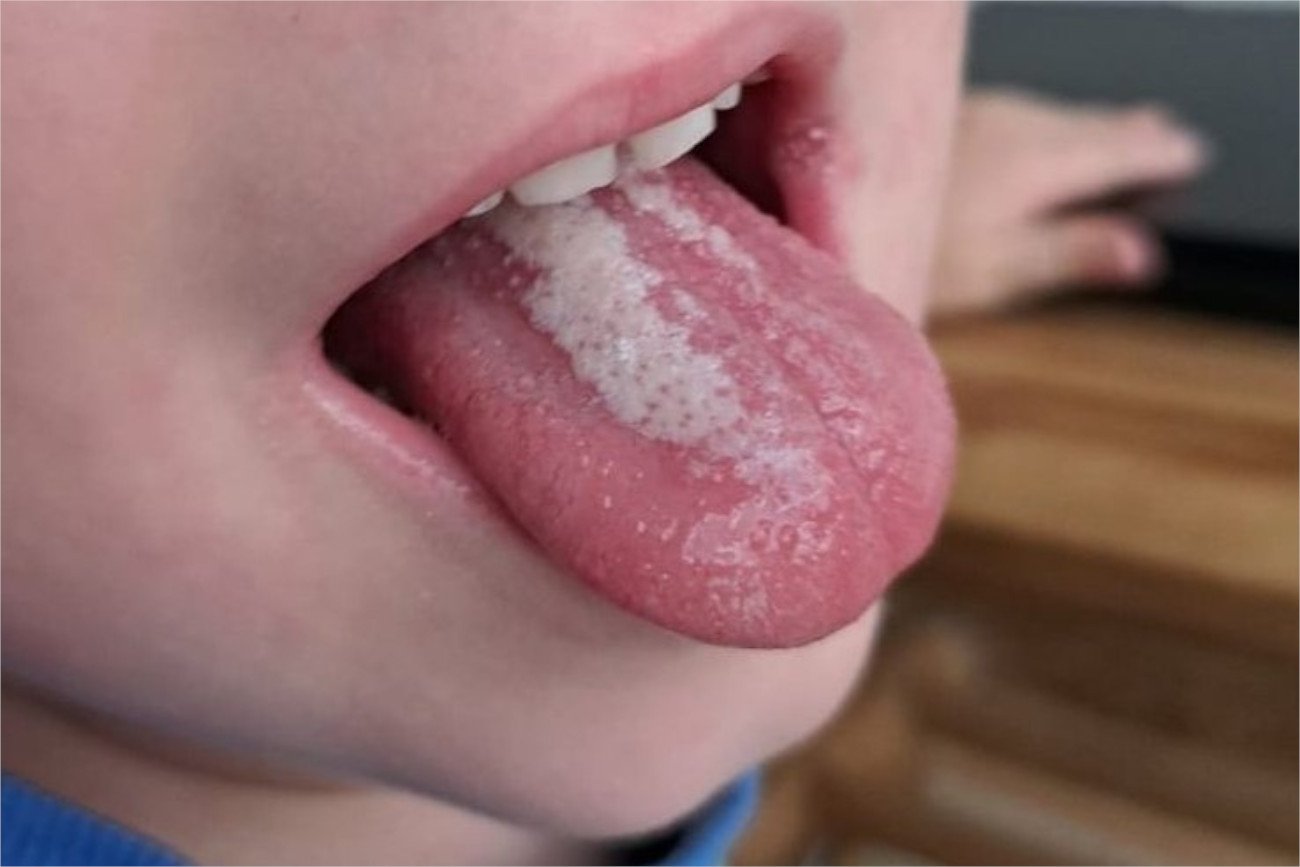 Biały nalot lub malinowy język, wysypka, wysoka gorączka i wymioty to najbardziej charakterystyczne objawy szkarlatyny.