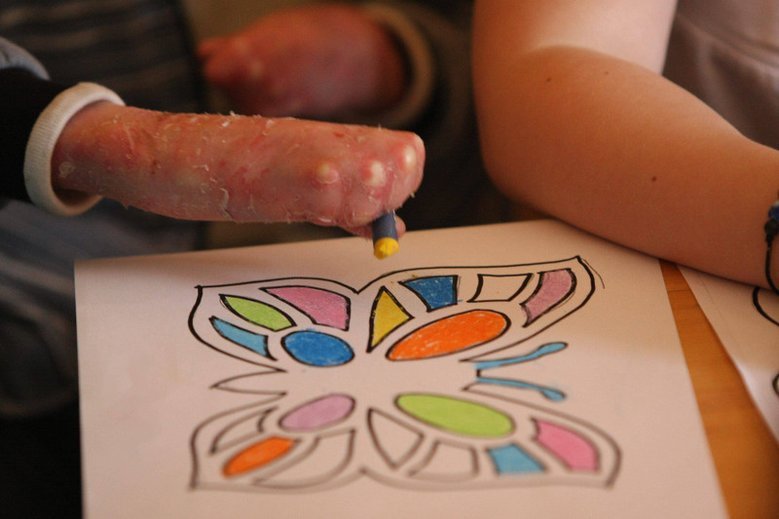 Chorzy na EB nie dostaną refundacji opatrunków.