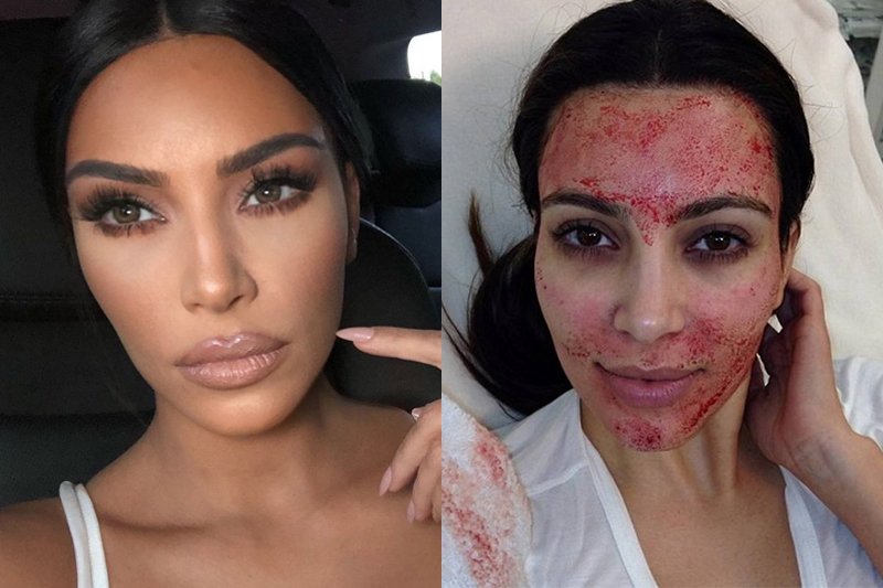 Kim Kardashian przyznaje się do stosowania "wampirzego liftingu"