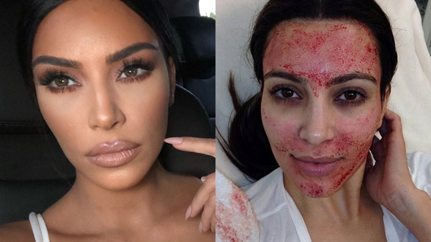 Kim Kardashian przyznaje się do stosowania "wampirzego liftingu"