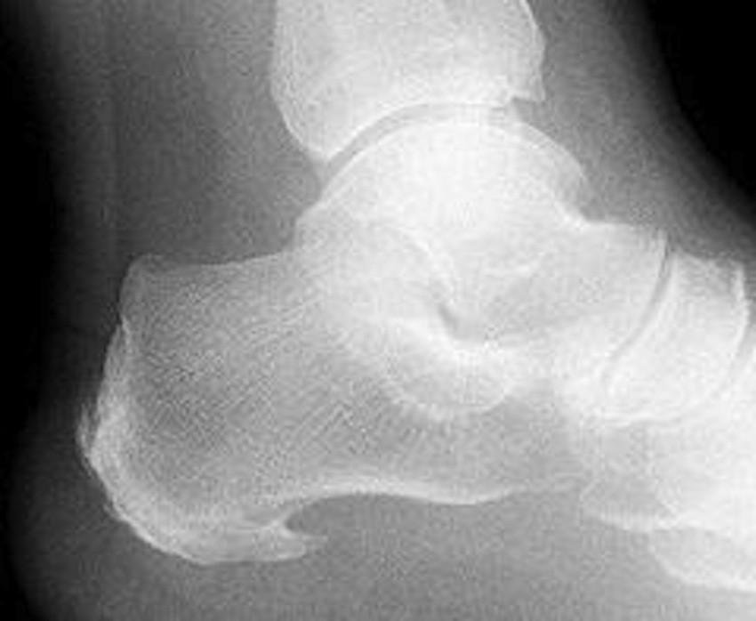 Rys. Ostroga piętowa - rentgen