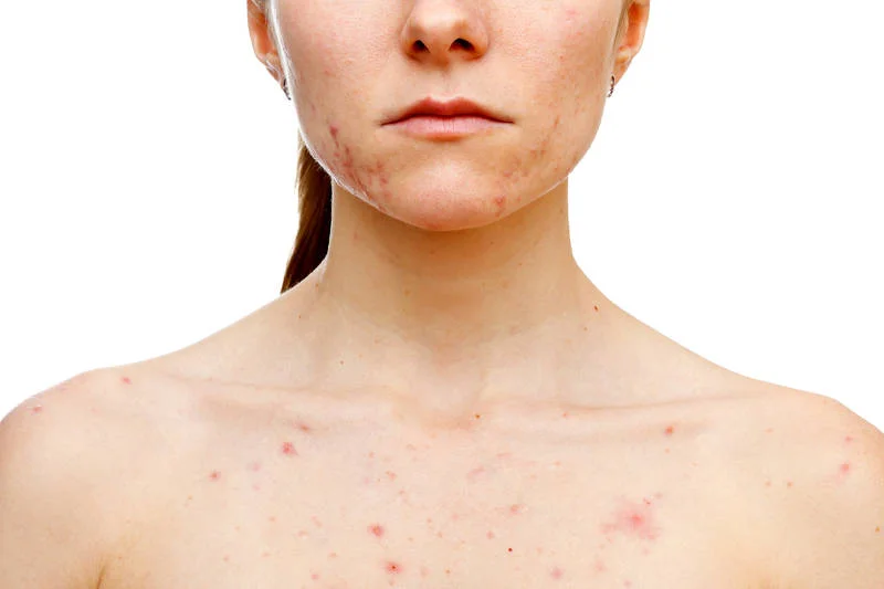 Trądzik często pojawia się na dekolcie i na plecach. Trzeba go leczyć dermatologicznie. Same specyfiki z apteki czy perfumerii stosowane partyzancko - nie pomogą