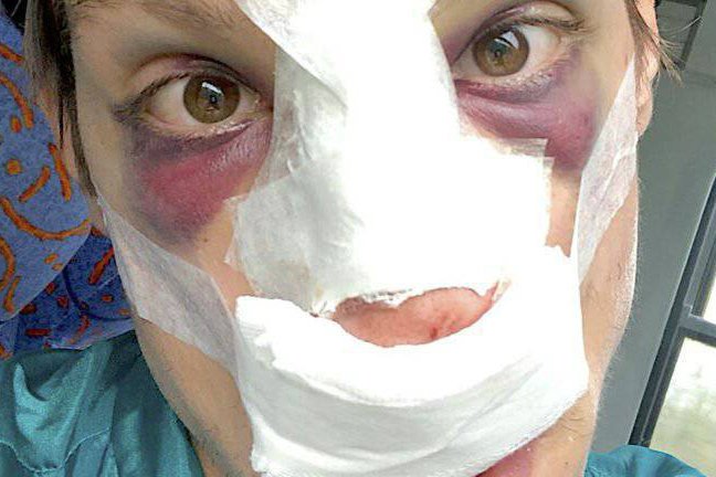 Aktor Eryk Kulm zrobił operację plastyczną nosa.