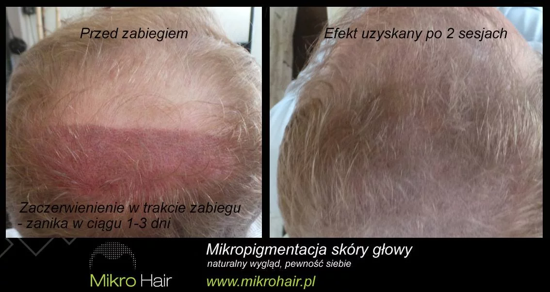Efekty metody Mikropigmentacji włosów