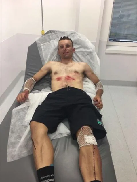 Tak wyglądał Rafał Majka, po wypadku na tegorocznym Tour de France.