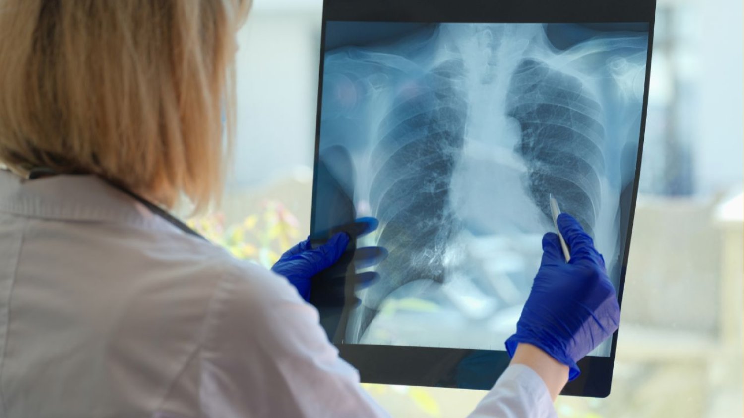 – Każdy pacjent z wrodzoną łamliwością kości jest inny i każda historia rodziny obciążonej tą chorobą jest inna – mówi prof. Elżbieta Jakubowska-Pietkiewicz.