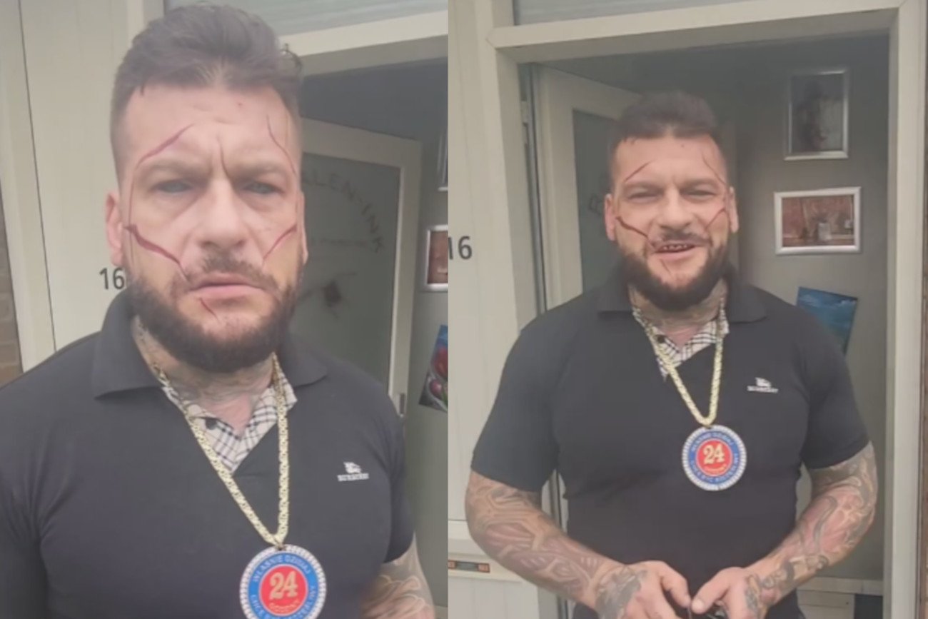 Popek znów pociął sobie twarz?