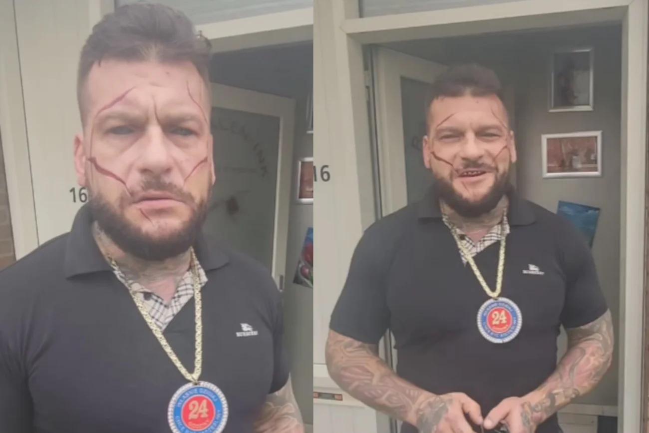 Popek znów pociął sobie twarz?