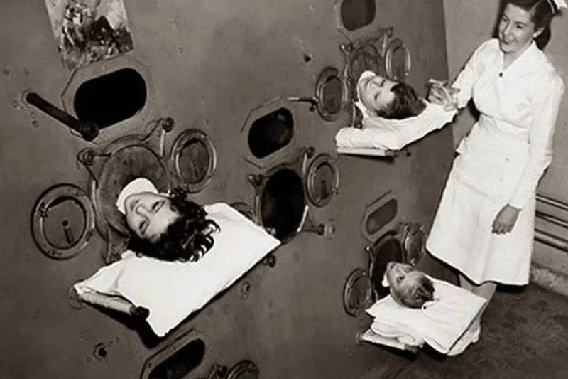 Żelazne płuco – urządzenie, które ratowało życie dzieciom chorym na polio, u których wystąpiło porażenie mięśni oddechowych. Stosowane w pierwszej połowie XX w.