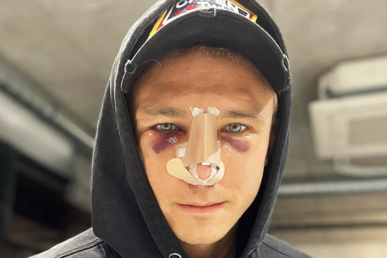 Jakub Rzeźniczak pokazał twarz po operacji nosa. Zareagował na niemiły wpis