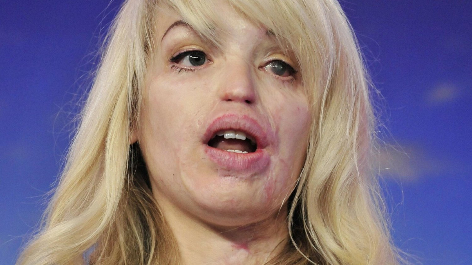 Katie Piper w 2010 roku – dwa lata po tym, jak została oblana na ulicy kwasem