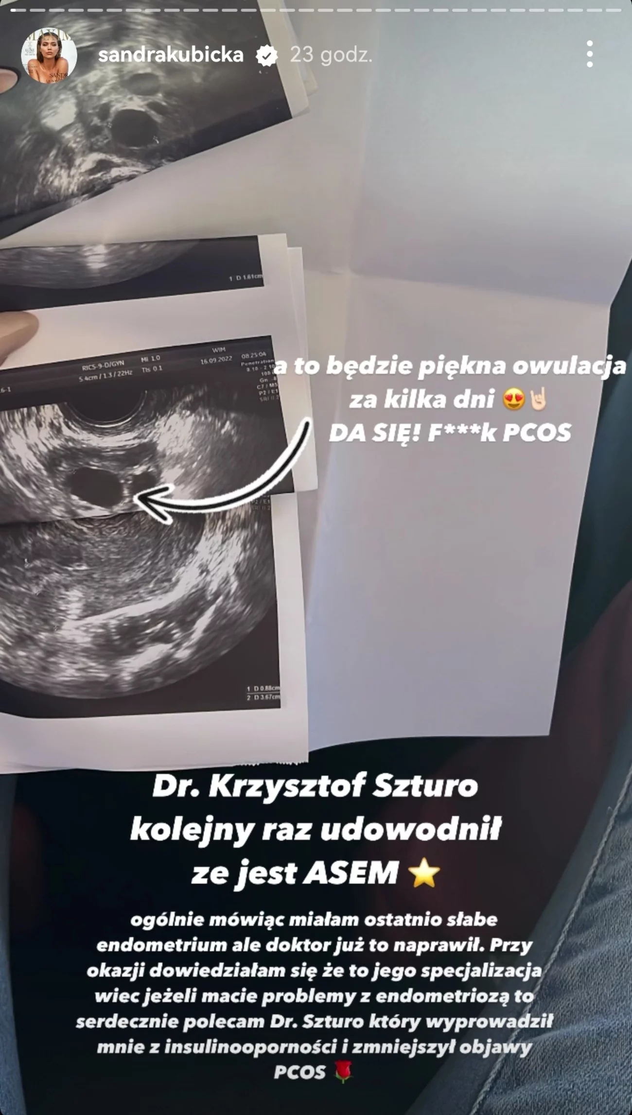 Sandra Kubicka wcale nie rozstała się z Baronem. Wrzuciła zdjęcie USG