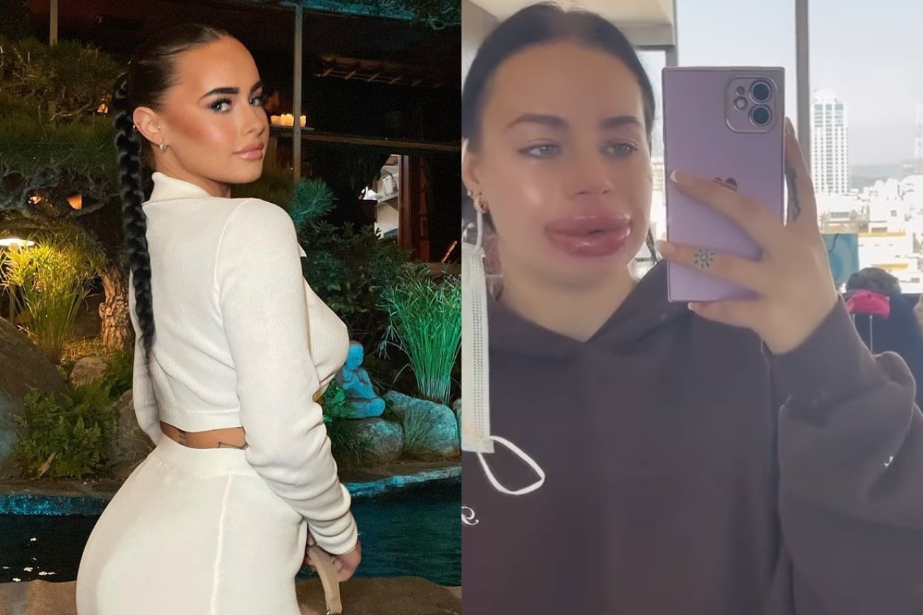 Influencerka, Jessica Burko powiększyła usta. Po zabiegu była załamana