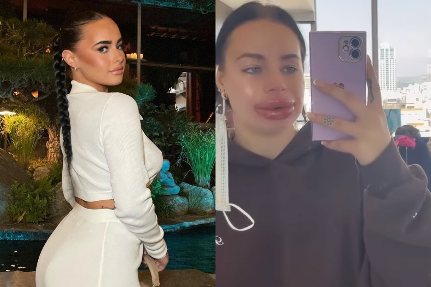 Influencerka, Jessica Burko powiększyła usta. Po zabiegu była załamana