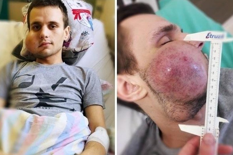 Maks ma 22 lata. Zachorował na bardzo rzadki nowotwór. Lekarze w Polsce nie są w stanie mu pomóc.