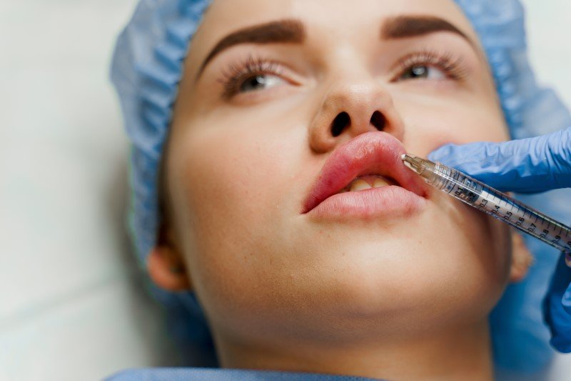 Powiększanie ust kwasem hialuronowym to jeden z najczęściej wykonywanych zabiegów medycyny estetycznej