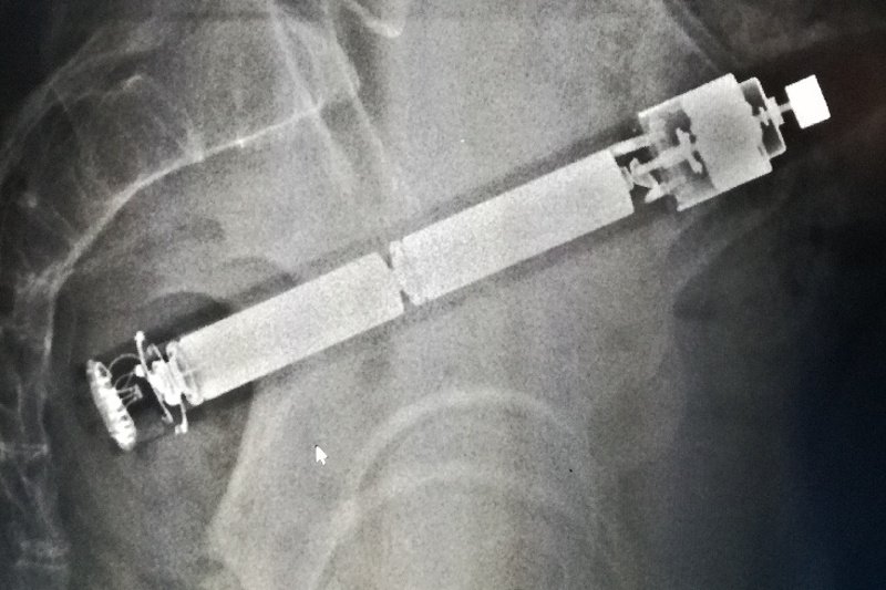 Laik nie od razu zorientuje się, co widać na tym zdjęciu rentgenowskim. Lekarz na pierwszy rzut oka wie, że jest to ciało obce w odbytnicy.