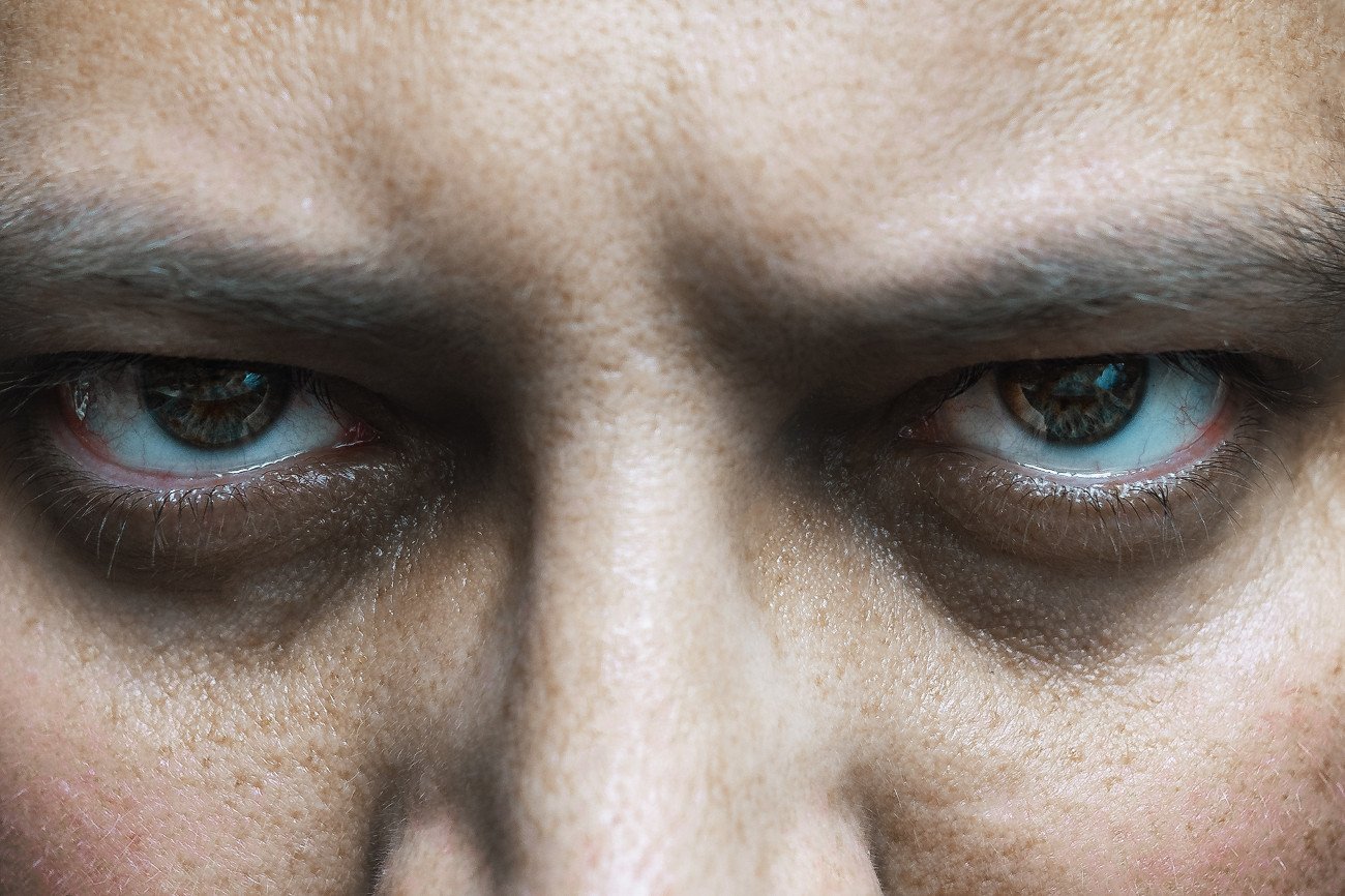 Mówi się o pewnych cechach charakterystycznych w wyglądzie chorego na amyloidozę serca, takich jak zasinienia wokół oczu, które w piśmiennictwie anglosaskim określa się jako „oczy szopa” - chodzi o ciemne sińce wokół oczu.