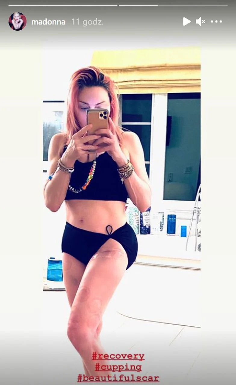 Zdjęcie na którym widoczne są zarówno ślady po bańkach jak i blizna pooperacyjna trafiły na instastory piosenkarki