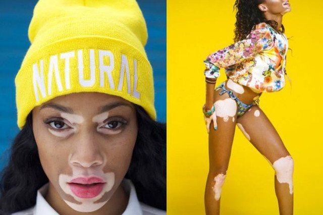 Chantelle Winnie. Czarnoskóra modelka z bielactwem, która podbija świat mody.